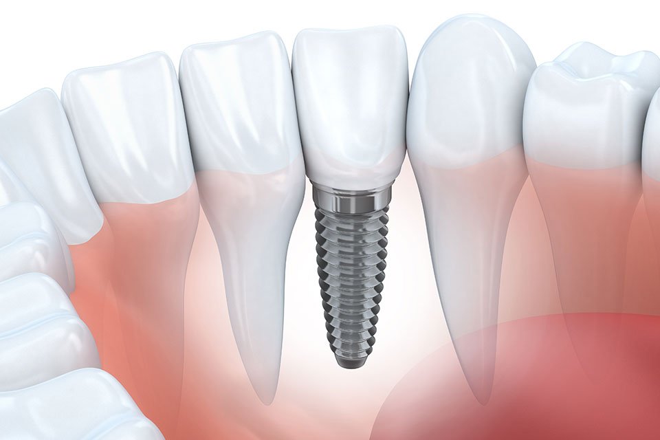 Implantet dentare: Zgjidhja moderne për një buzëqeshje të shëndetshme